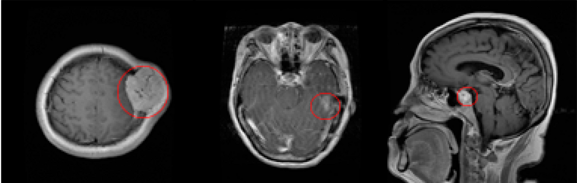 Brain Cancer Image Synthesis